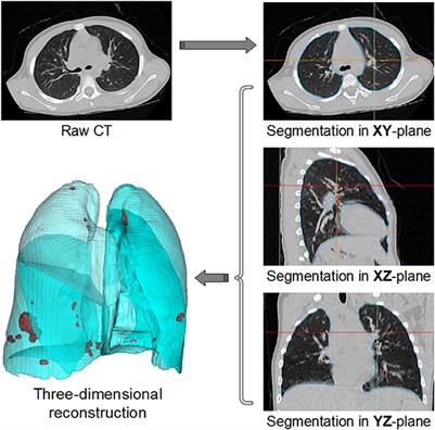 Six-month follow-up after recovery of COVID-19 Delta variant survivors via CT-based deep learning